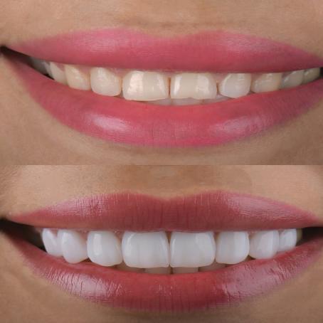 Repair of composite or veneers